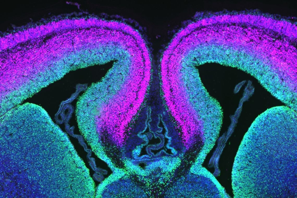Research identifies the main gene that causes developmental disability syndrome
