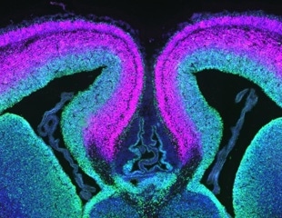 Research identifies the main gene that causes developmental disability syndrome
