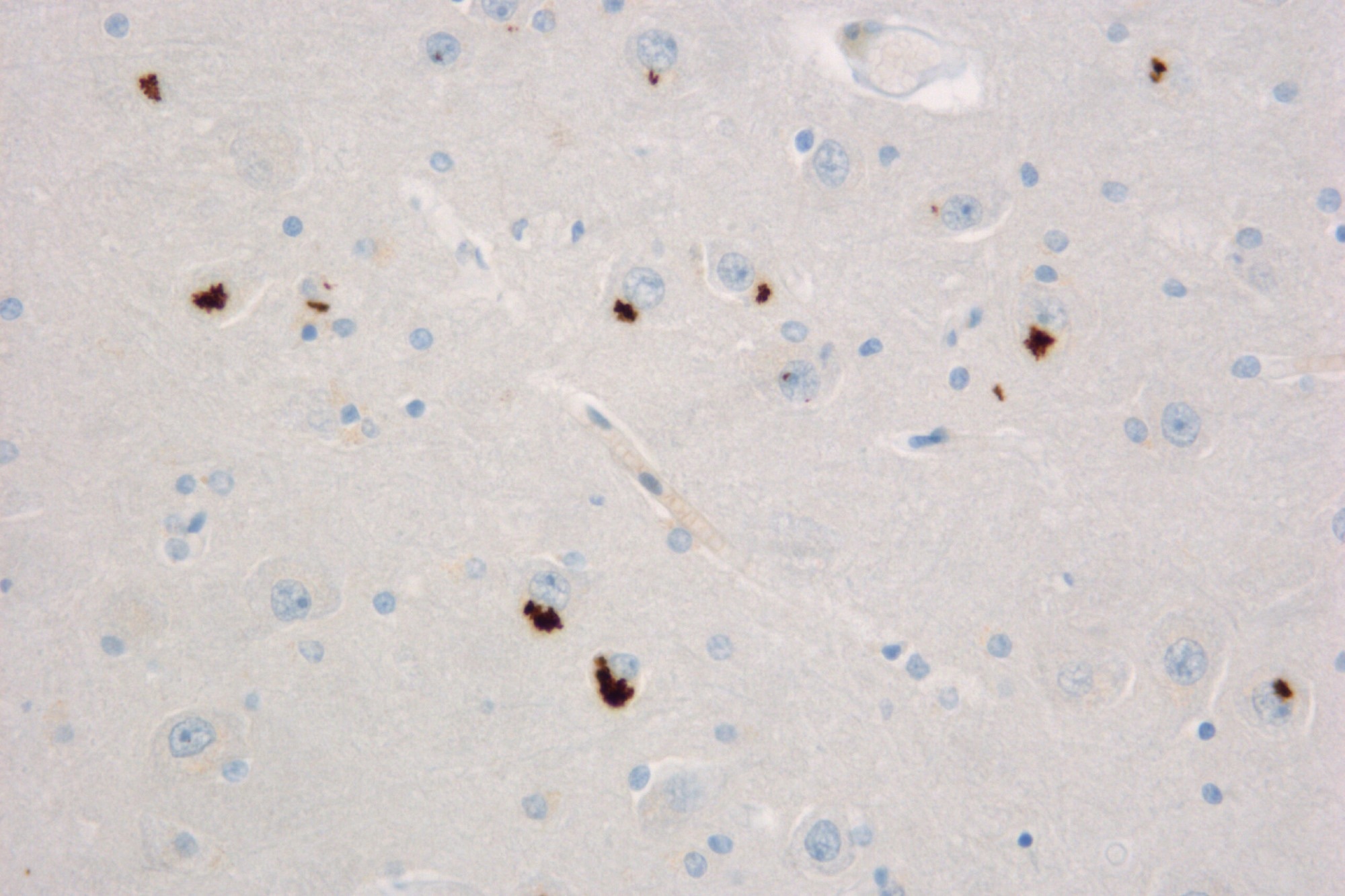 Researchers get funding to develop a vaccine against ALS disease