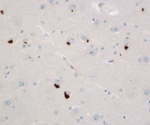 Researchers get funding to develop a vaccine against ALS disease