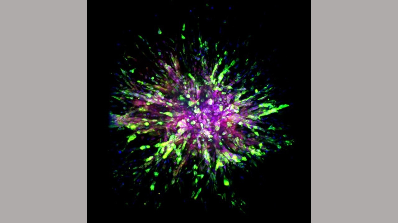 Researchers identify key molecular differences between initial and metastatic tumors