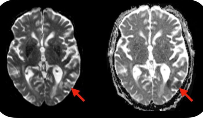 Simple blood test helps identify patients developing neurotoxic side effects