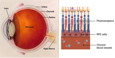 Adaptive optics imaging helps visualize the pathogenesis of choroideremia