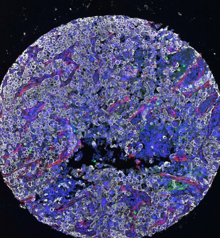 Encouraging breakthroughs in eliminating therapy-resistant cancer cells