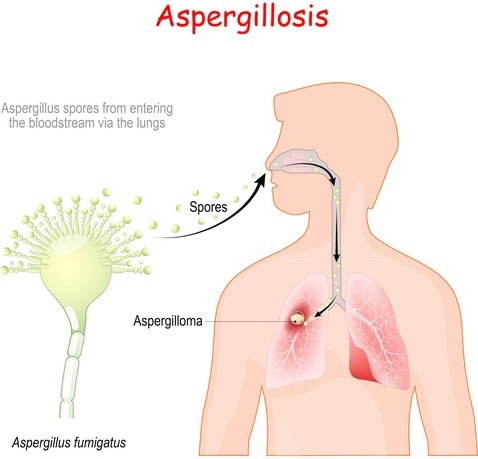 Genomic research helps in tackling the fatal complications of fungal infections