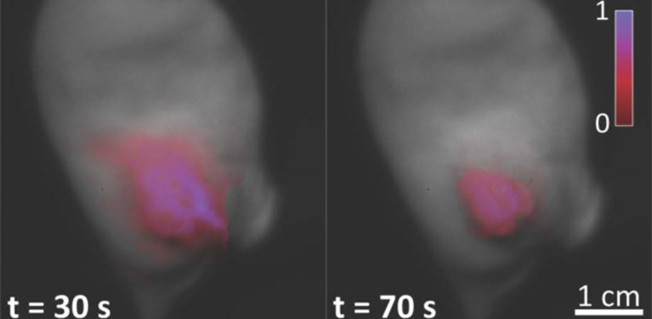 New approach to identify cancerous tissue for surgical removal