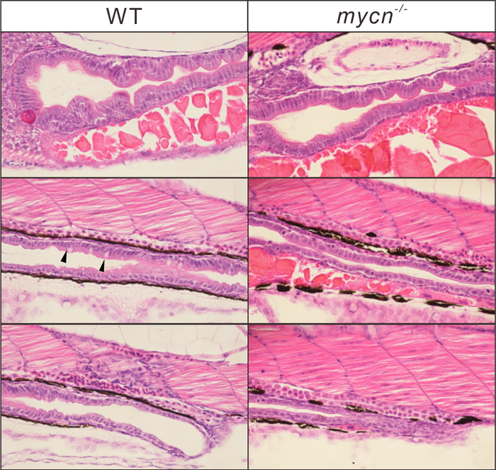 Low protein synthesis in humans causes rare intestinal disease