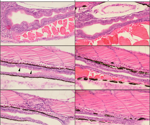 Low protein synthesis in humans causes rare intestinal disease