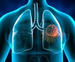 Lung cancer treatment with protein insights