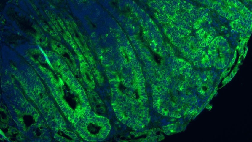 The critical role of amino acid sensing pathways in driving colorectal cancer
