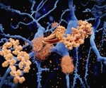 New technologies reveal cross-cutting breakdowns in Alzheimer’s disease