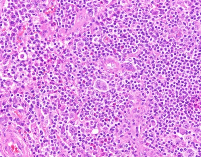 Whole genome sequencing might help better assess tumor evolution