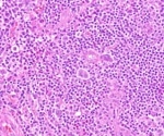 Whole genome sequencing might help better assess tumor evolution