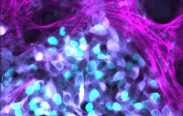 Randomness governs the responsiveness of tumor cells to chemotherapy