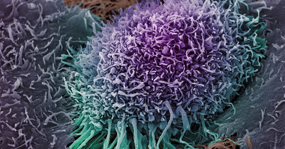 High correlation between the product of a gene in the majority of cancers
