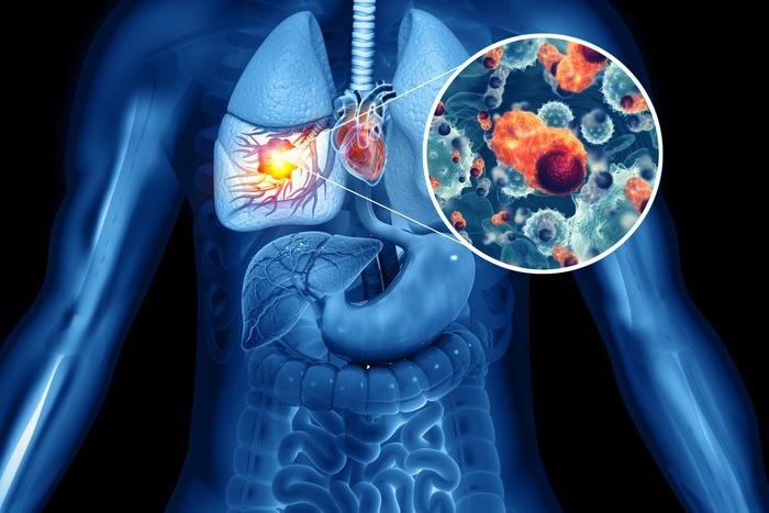 Insights into mechanisms impacting NSCLC disease progression