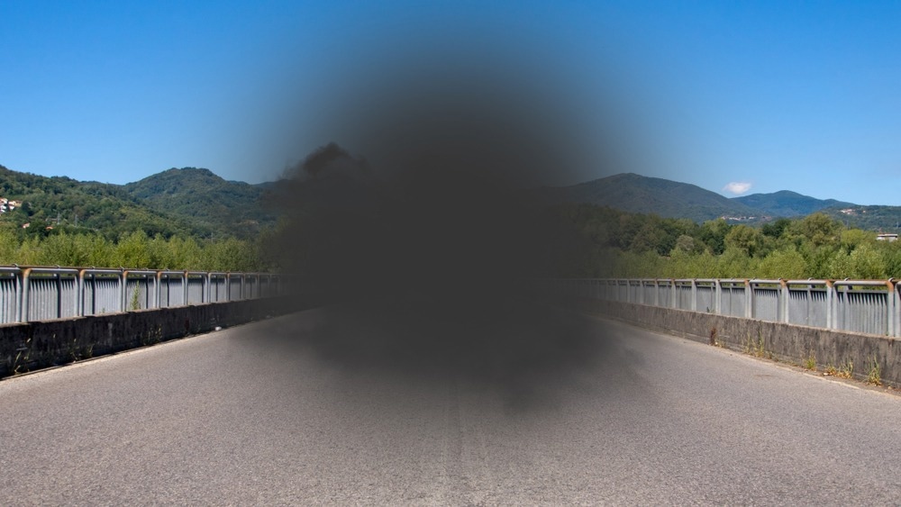 Age-related macular degeneration