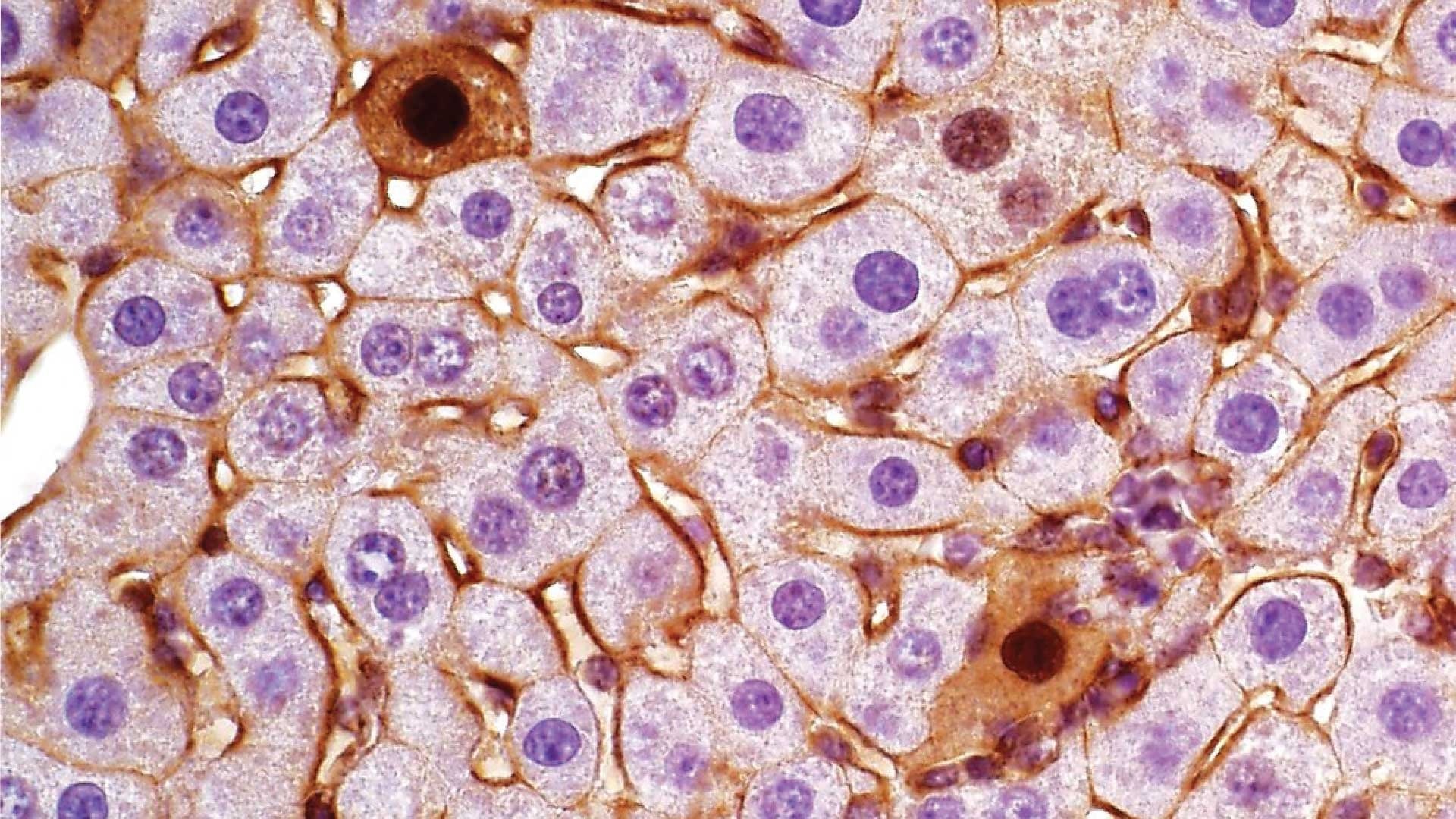 CRISPR-Cas9 Driven Gene-Editing Tool Models Liver Cancer Tumor Subtypes