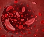 Sickle Cell Disease Cure? Prime Editing Offers Hope for Blood Disorder