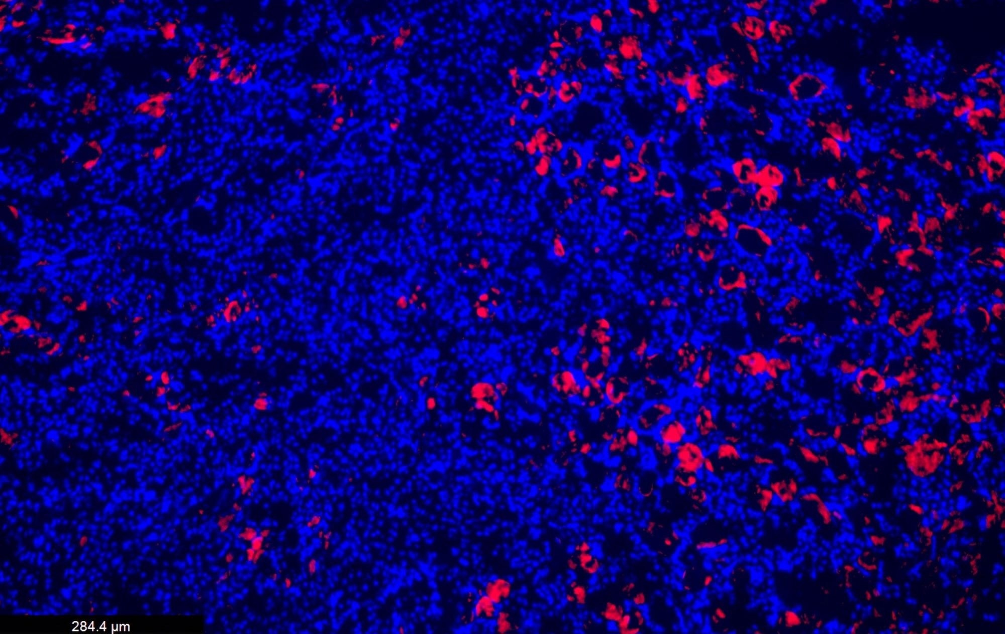 Genetic Variants of TNFAIP3 May Protect the Kidneys from Damage