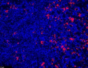 Genetic Variants of TNFAIP3 May Protect the Kidneys from Damage