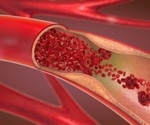 New Genes Associated With SCAD Identified