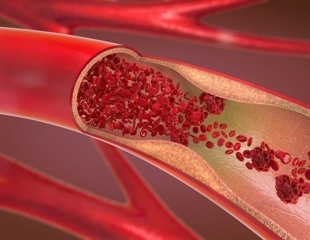 New Genes Associated With SCAD Identified