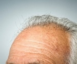 Hair Regrowth with Softening Stiff Hair Follicle Stem Cells with microRNA