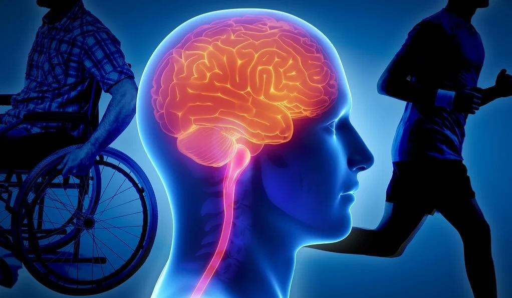 Identifying the Genetic Variant That Increases Disease Severity in MS