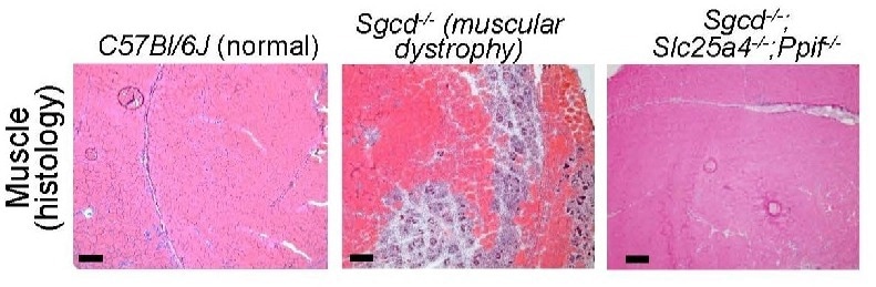 Gene Therapy Shows Promise for Muscular Dystrophy Patients