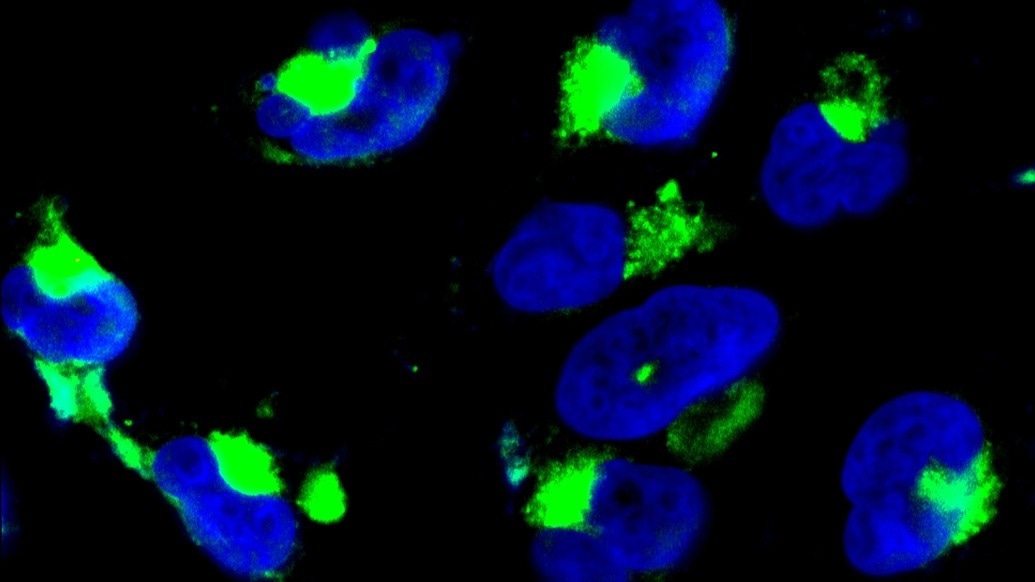 New Gene Therapy Shows Promise in Treating Gliomas