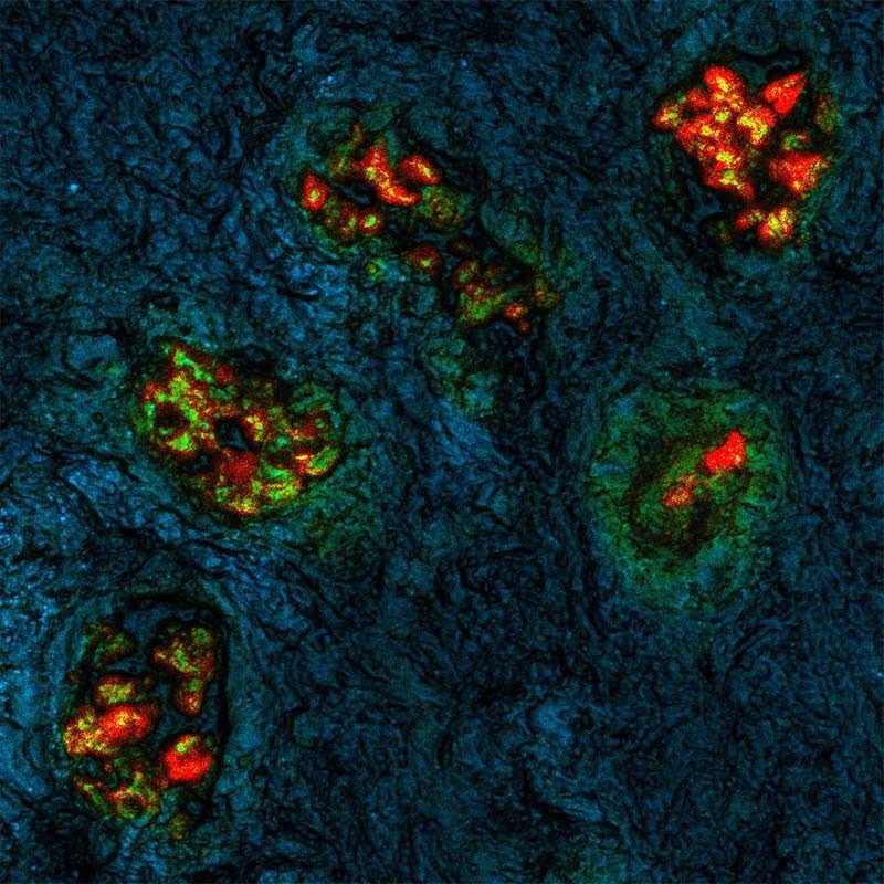 New Way to Visualize Tumors During Surgery