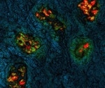 New Way to Visualize Tumors During Surgery
