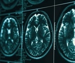 More Genes Changed By Early Life Stress Than Head Injury