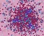 Decoding the Dynamics of Multiple Sclerosis Lesions