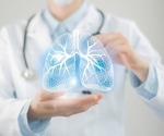 Inverse relationship found between anti-inflammatory macrophages and NK cells/T cells in lung cancer