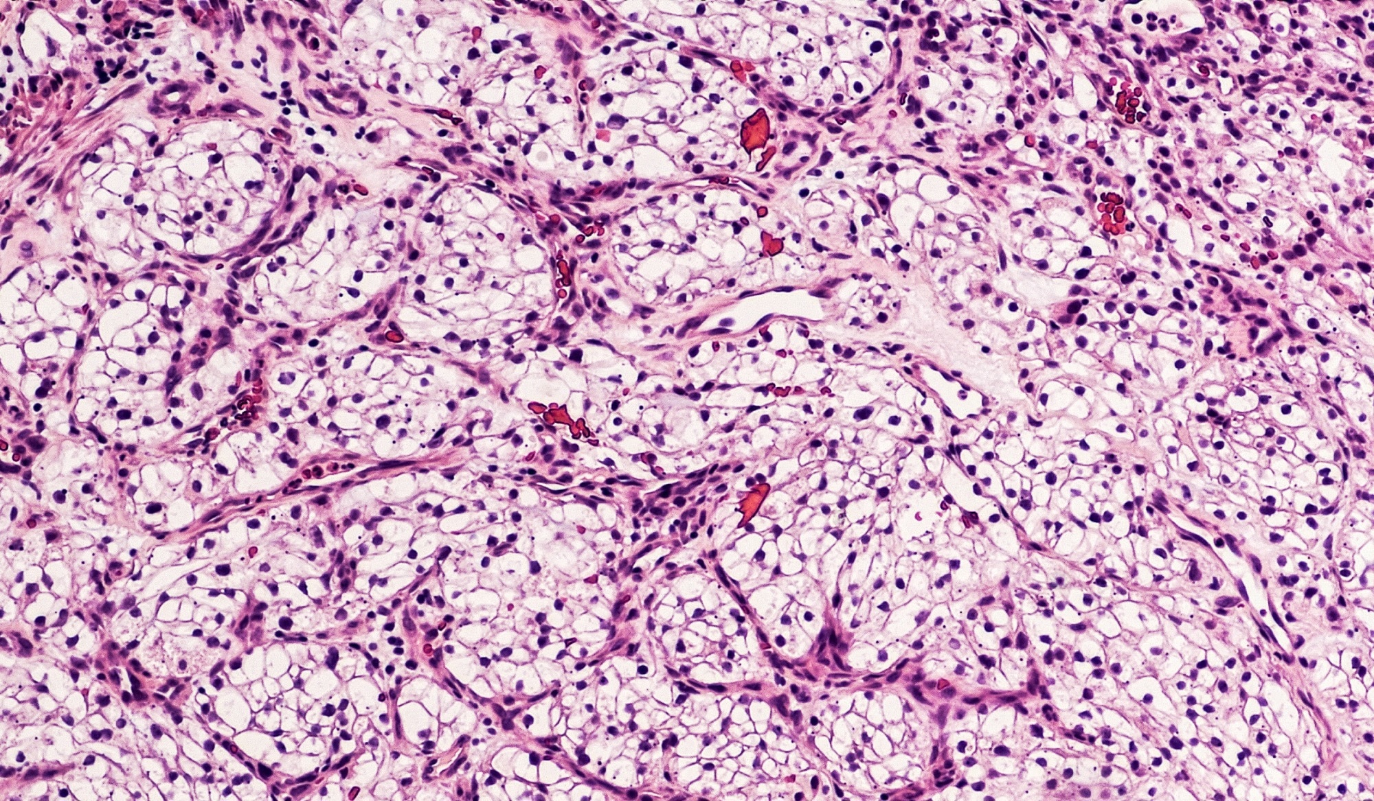 ​​​​​​​Study: Identification of clear cell renal cell carcinoma subtypes by integrating radiomics and transcriptomics. Image Credit: David A Litman/Shutterstock.com