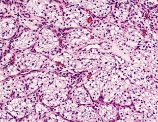 Study Identifies Three Distinct Subtypes of Clear Cell Renal Cell Carcinoma Using Radiomics and Transcriptomics