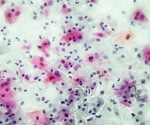 Novel Drug Targets in Gardnerella Vaginalis: A Bioinformatics Approach to Combat Bacterial Vaginosis