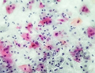 Novel Drug Targets in Gardnerella Vaginalis: A Bioinformatics Approach to Combat Bacterial Vaginosis