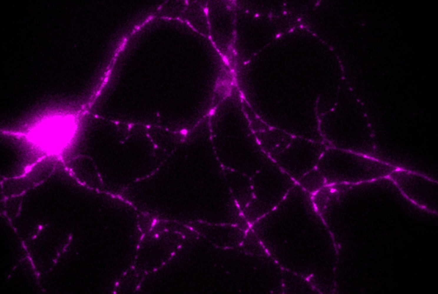 Enzyme Therapy Shows Promise for Parkinson