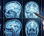 The Lasting Effects of COVID-19 on the Brain