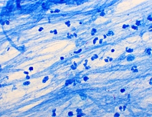 How CRISPRi is Helping Combat Drug-Resistant Tuberculosis