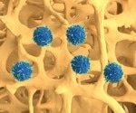 Immunotherapy Advances: CAR T Cells Targeting GD2 Offer Hope for Glioma Patients