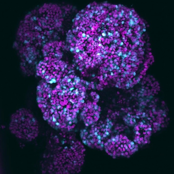 Novel Organoid Model Sheds Light on Human Pancreas Development and Disease