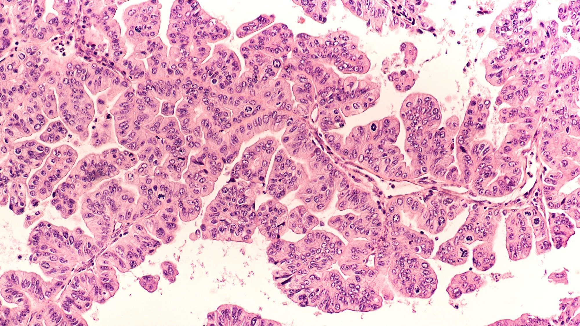 Micrograph of a serous papillary carcinoma (adenocarcinoma) of ovary, with intricately branching papillae.