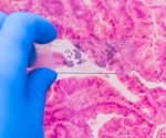 Unlocking Cancer’s Secret Strategy: Tumor Cells Work Together To Survive