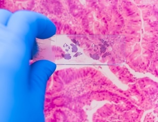Unlocking Cancer’s Secret Strategy: Tumor Cells Work Together To Survive