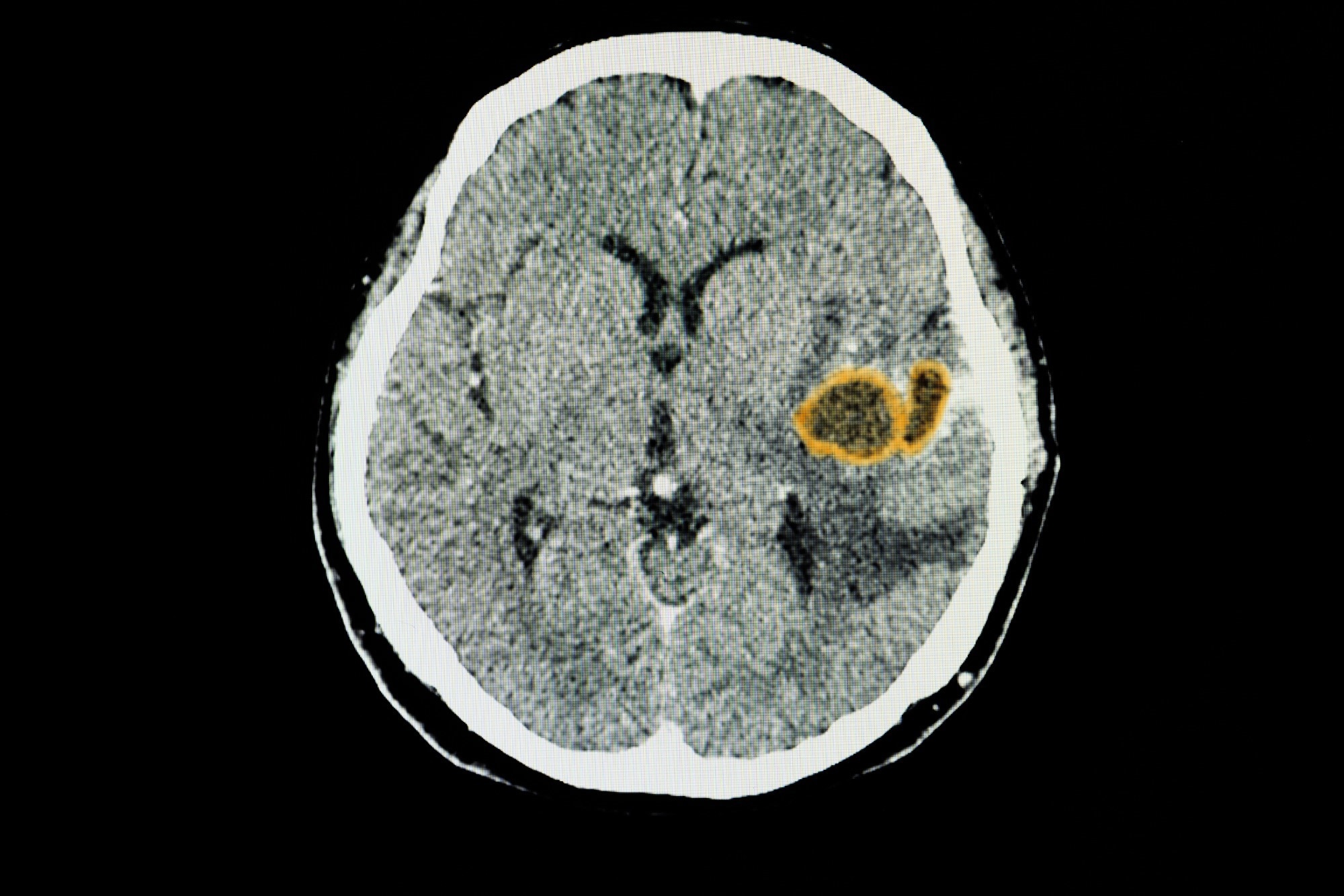 A CT brain scan with contrast of a patient showing ring shaped enhancing CT lesions.