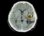 RNA Splicing Errors May Hold the Key to Beating Gliomas Using Immunotherapy